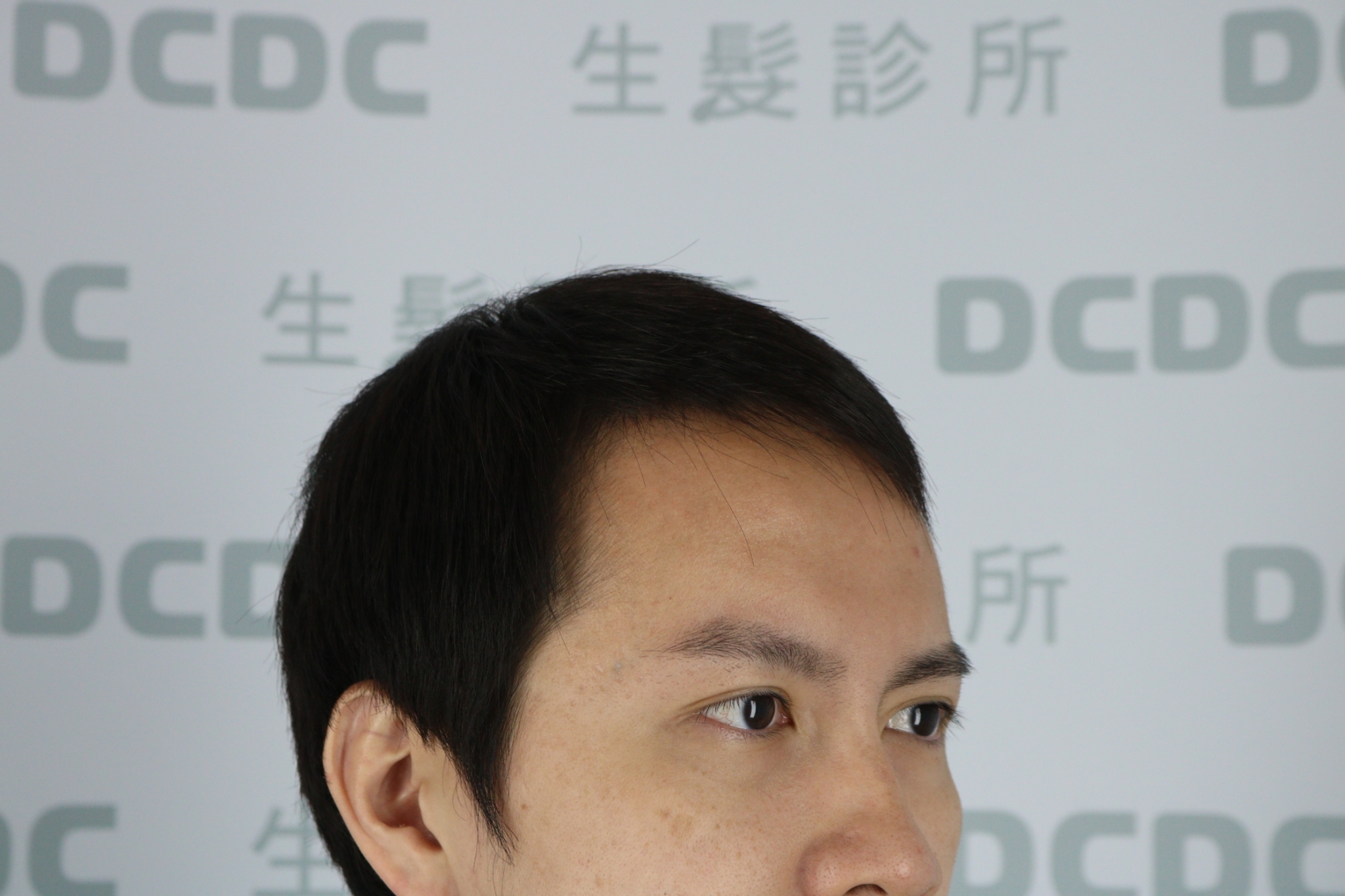 DCDC生髮診所-男性高額頭兩側額角稀疏術前側臉角度評估